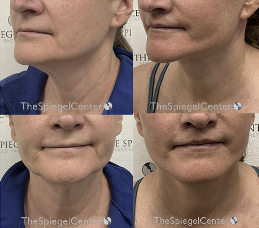 neck lift before and after 