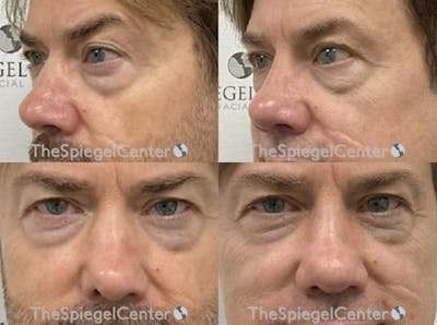 Revision Rhinoplasty Before & After Gallery - Patient 407197 - Image 1