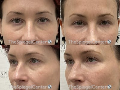 Tear Trough / Under Eye Fillers Before & After Gallery - Patient 357919 - Image 1