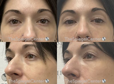 Tear Trough / Under Eye Fillers Before & After Gallery - Patient 427961 - Image 1