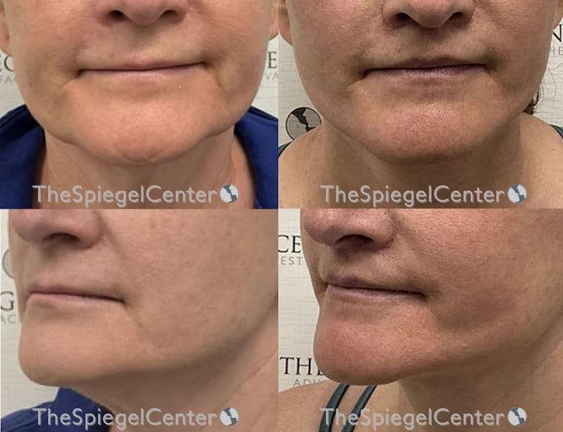 Lip Lift Before & After Gallery - Patient 780742 - Image 1