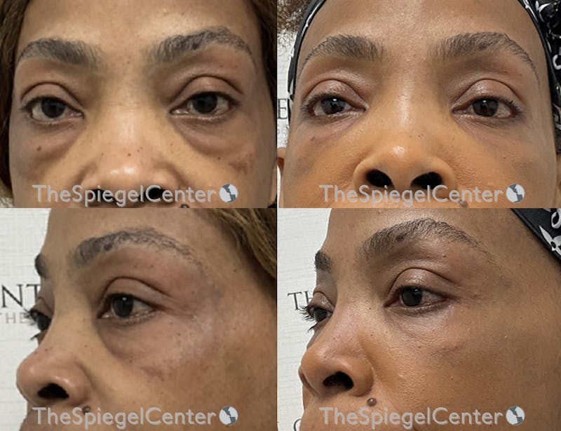Tear Trough / Under Eye Fillers Before & After Gallery - Patient 130858 - Image 1