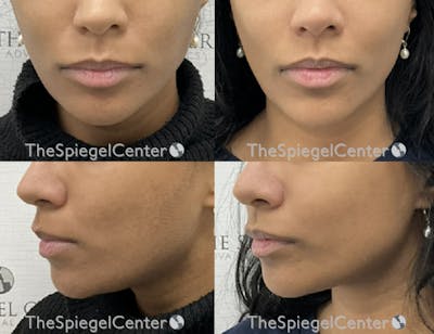 Chin Filler Before & After Gallery - Patient 254016 - Image 1
