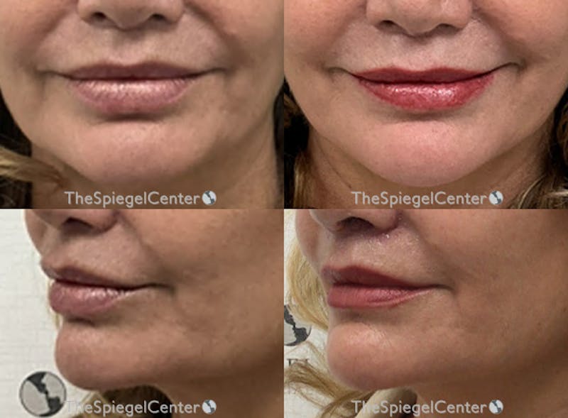 Nasolabial Fold Filler Before & After Gallery - Patient 174295 - Image 1