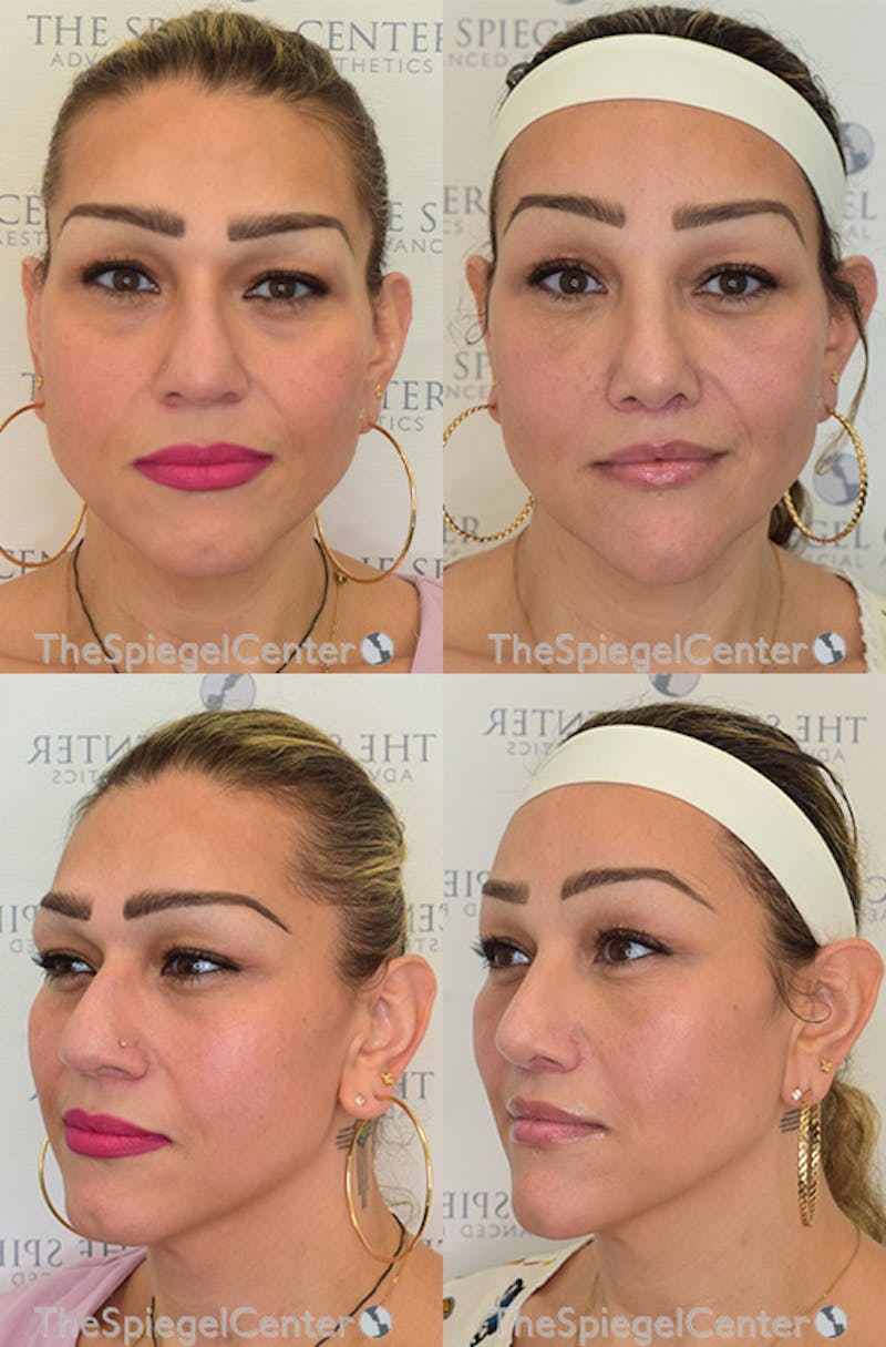 FFS Before & After Gallery - Patient 190884 - Image 1