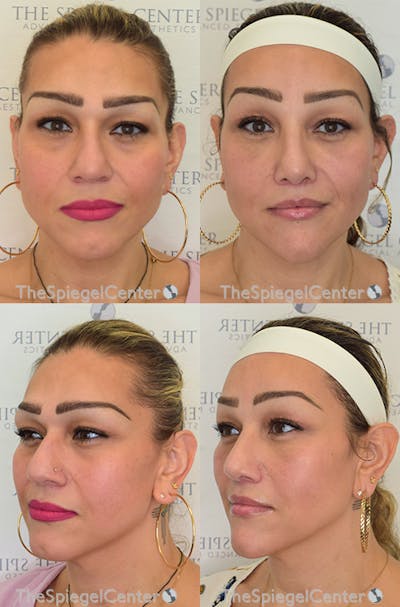 FFS Before & After Gallery - Patient 190884 - Image 1
