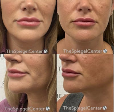 Chin Filler Before & After Gallery - Patient 166124 - Image 1