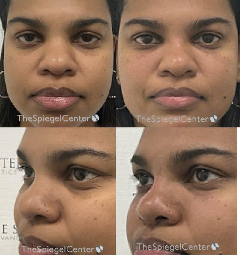 Non-Surgical Rhinoplasty / Nose Filler Before & After Gallery - Patient 871726 - Image 1