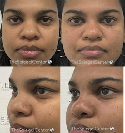 Non-Surgical Rhinoplasty / Nose Filler Before & After Gallery - Patient 871726 - Image 1