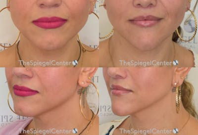 Mandible Contouring Before & After Gallery - Patient 360296 - Image 1