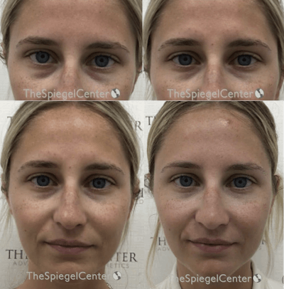 Temple Filler Before & After Gallery - Patient 157140557 - Image 1