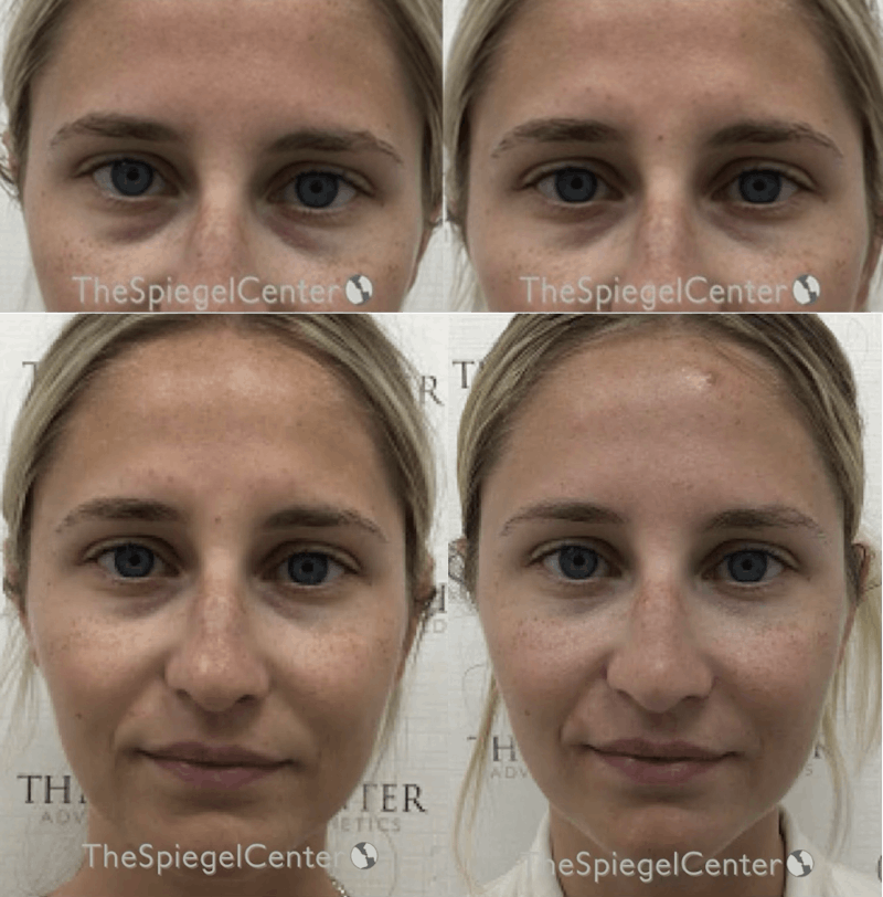 Temple Filler Before & After Gallery - Patient 157140557 - Image 1
