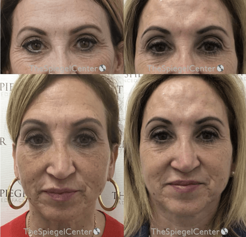 Temple Filler Before & After Gallery - Patient 157140662 - Image 1