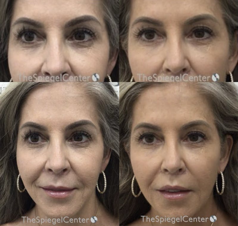 Temple Filler Before & After Gallery - Patient 157140651 - Image 1