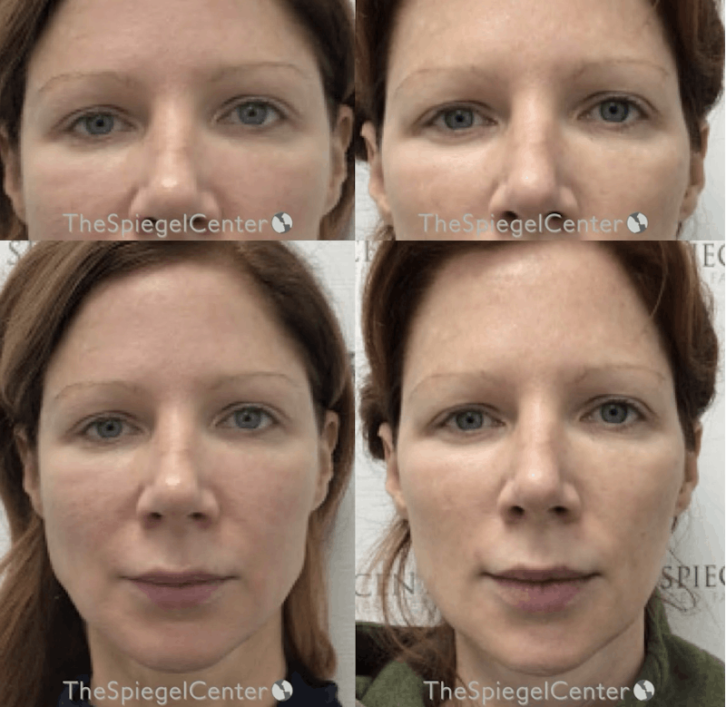 Temple Filler Before & After Gallery - Patient 888057 - Image 1