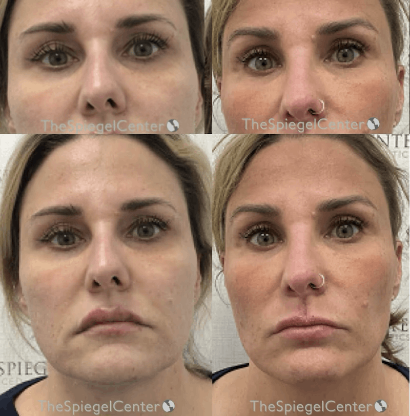 Temple Filler Before & After Gallery - Patient 245633 - Image 1