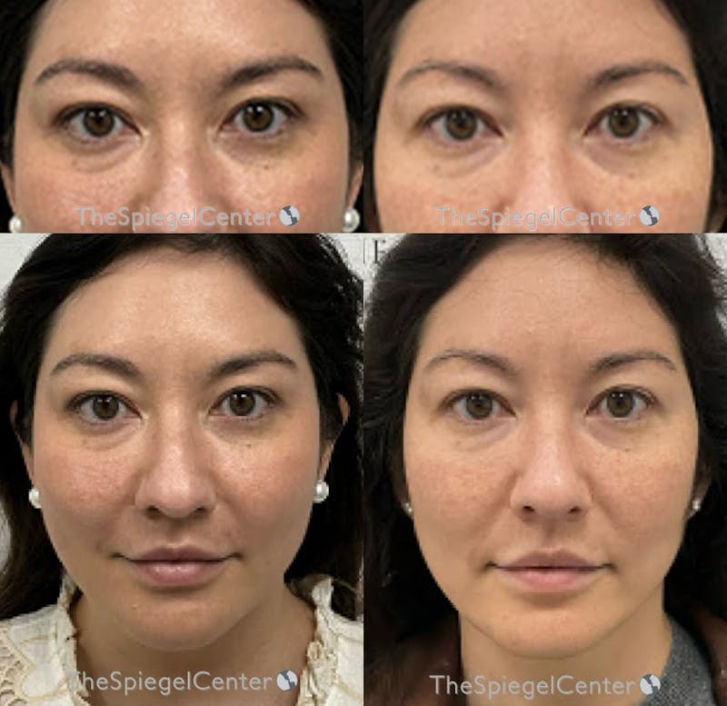Temple Filler Before & After Gallery - Patient 220072 - Image 1