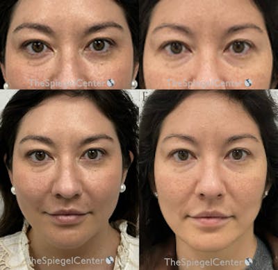 Temple Filler Before & After Gallery - Patient 220072 - Image 1