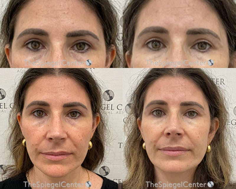 Temple Filler Before & After Gallery - Patient 408228 - Image 1