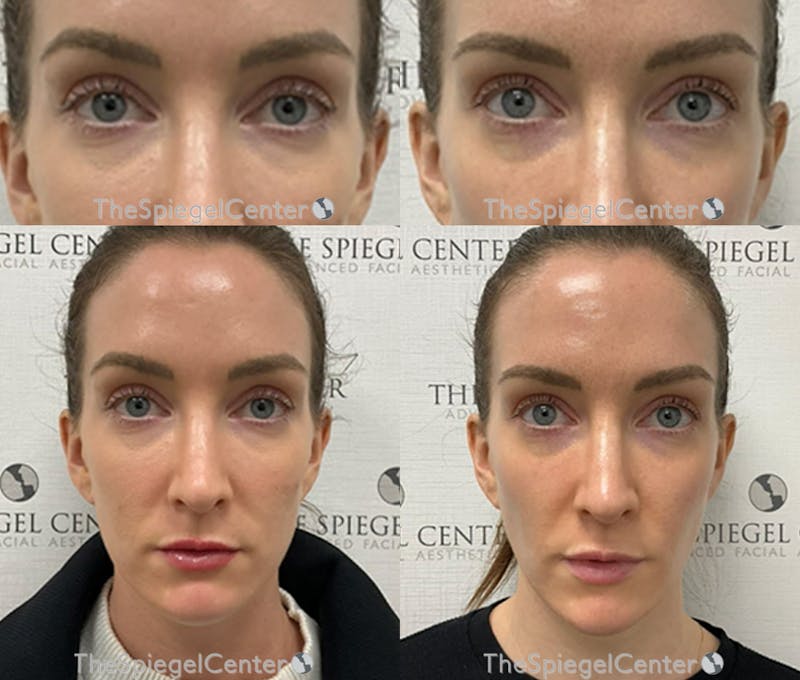 Temple Filler Before & After Gallery - Patient 290635 - Image 1