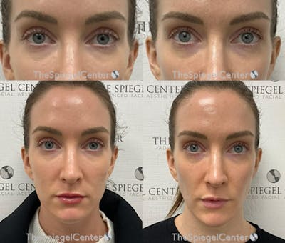 Temple Filler Before & After Gallery - Patient 290635 - Image 1