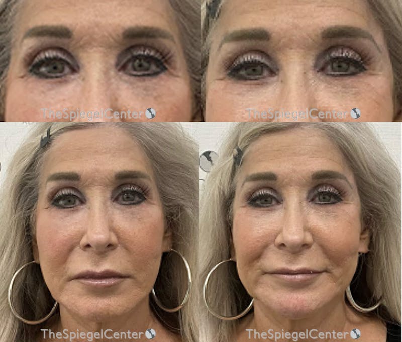 Temple Filler Before & After Gallery - Patient 503124 - Image 1