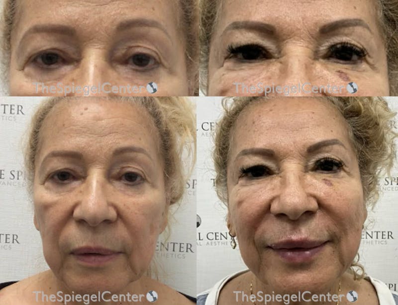 Temple Filler Before & After Gallery - Patient 870220 - Image 1