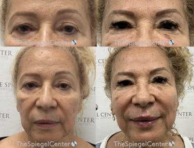 Temple Filler Before & After Gallery - Patient 870220 - Image 1
