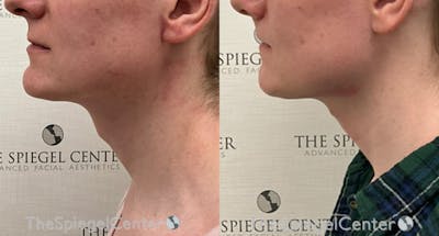 Trachea Shave Before & After Gallery - Patient 341677 - Image 1