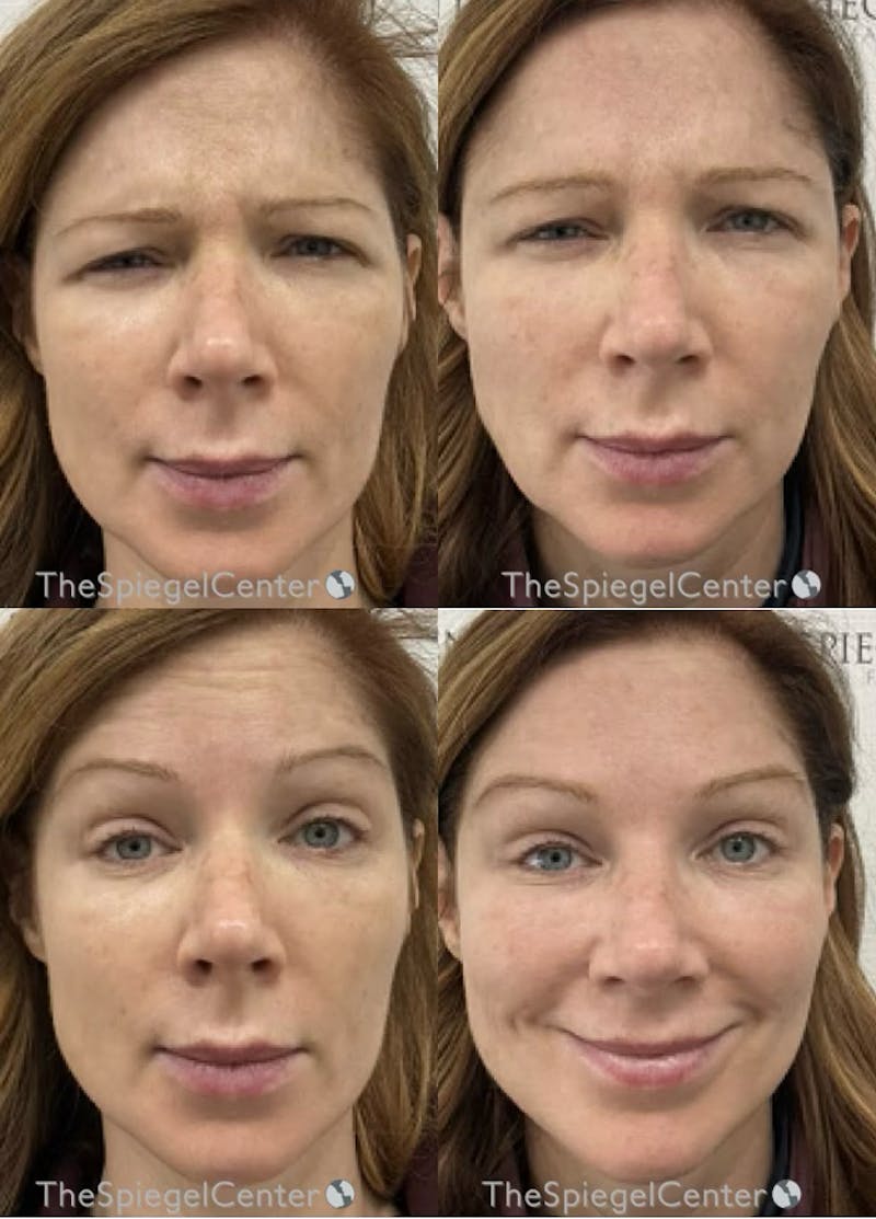 Botox / Dysport / Jeuveau / Xeomin Before & After Gallery - Patient 382726 - Image 1