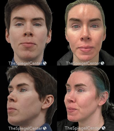 FFS Before & After Gallery - Patient 790884 - Image 1