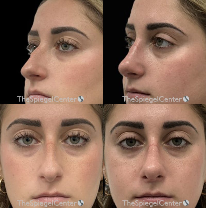 Rhinoplasty Before & After Gallery - Patient 773010 - Image 1