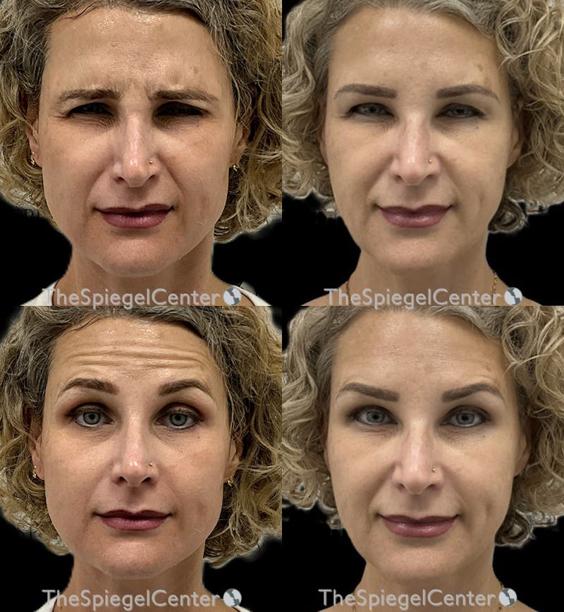Botox / Dysport / Jeuveau / Xeomin Before & After Gallery - Patient 287248 - Image 1