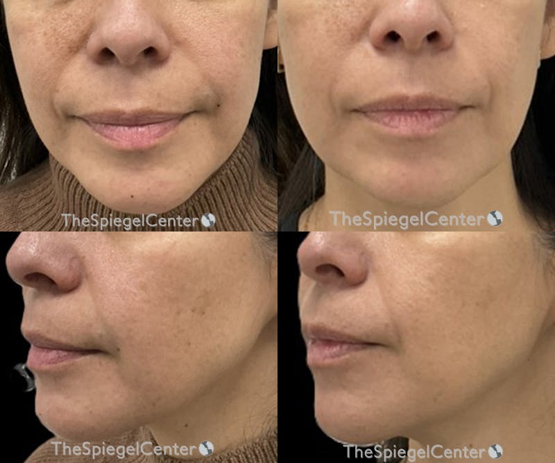 Nasolabial Fold Filler Before & After Gallery - Patient 335938 - Image 1