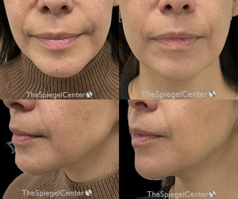 Chin Filler Before & After Gallery - Patient 202509 - Image 1