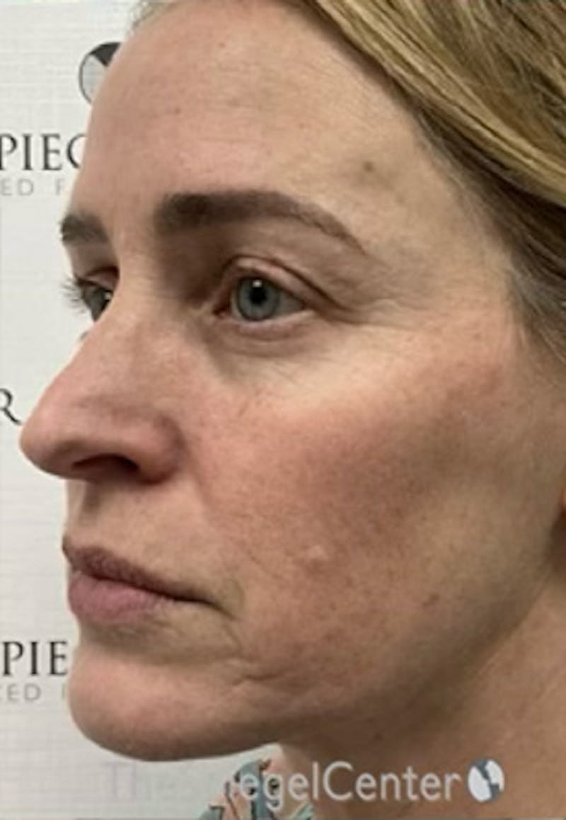 CO2 Laser Before & After Gallery - Patient 303110 - Image 3