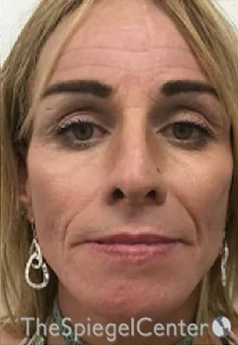 CO2 Laser Before & After Gallery - Patient 414483 - Image 2