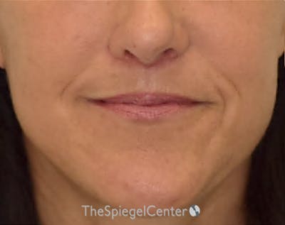 Ellacor Before & After Gallery - Patient 292708 - Image 2