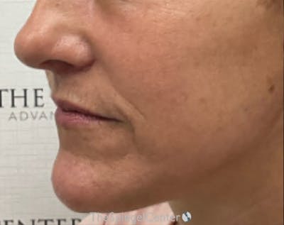 Ellacor Before & After Gallery - Patient 292708 - Image 4