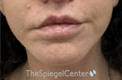 Ellacor Before & After Gallery - Patient 251638 - Image 2