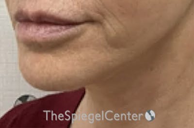 Ellacor Before & After Gallery - Patient 251638 - Image 3