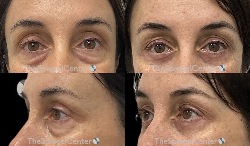 Blepharoplasty Before & After Gallery - Patient 974433 - Image 1