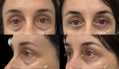 Blepharoplasty Before & After Gallery - Patient 974433 - Image 1