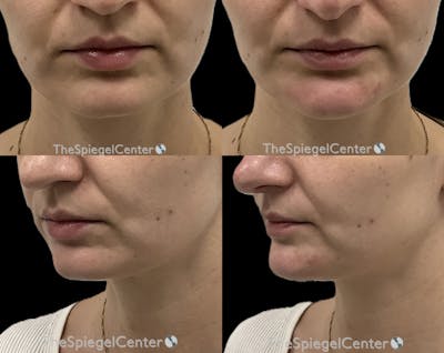 Chin Filler Before & After Gallery - Patient 269818 - Image 1