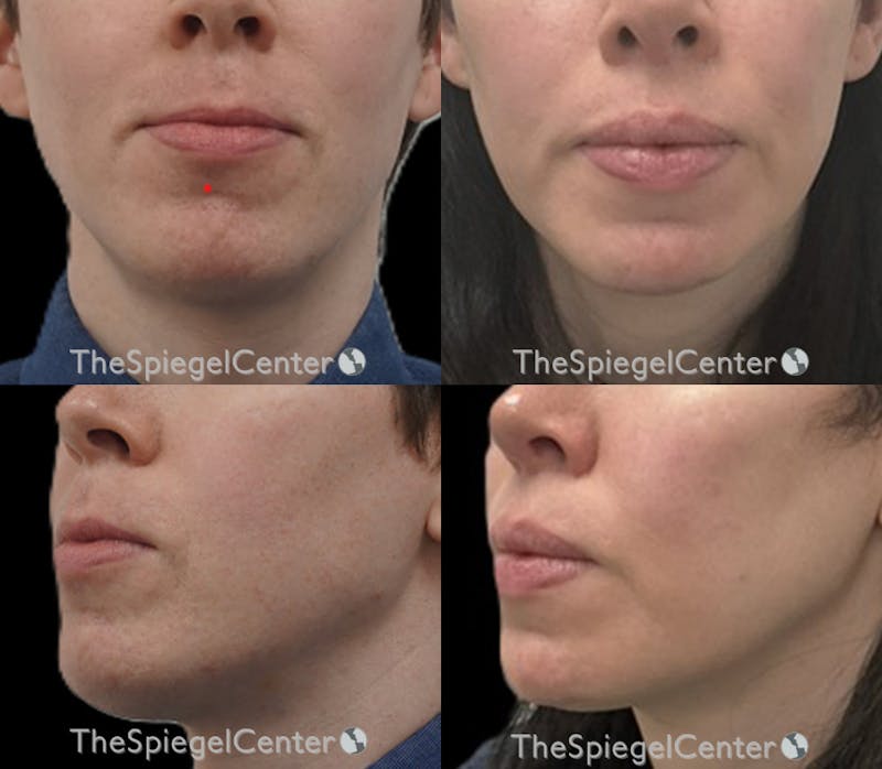 Mandible Contouring Before & After Gallery - Patient 230054 - Image 1