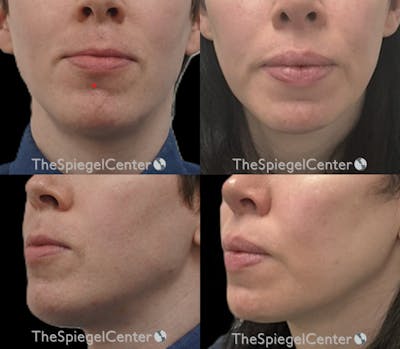 Mandible Contouring Before & After Gallery - Patient 230054 - Image 1