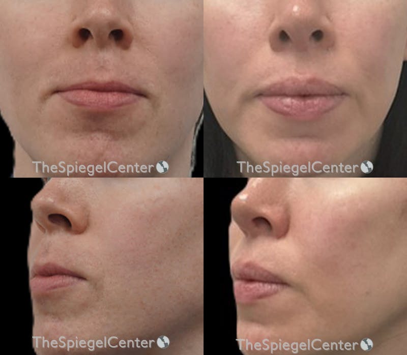 Lip Lift Before & After Gallery - Patient 399830 - Image 1
