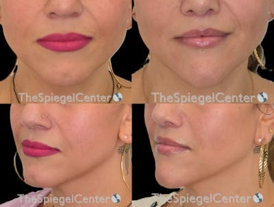Lip Lift Before & After Gallery - Patient 323216 - Image 1