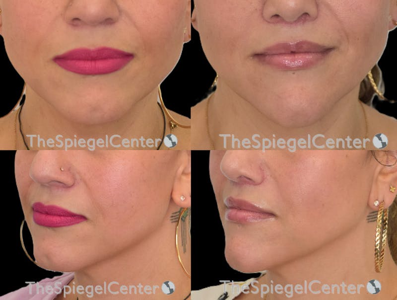 Lip Lift Before & After Gallery - Patient 323216 - Image 1