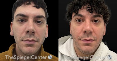 Ear Pinning / Otoplasty Before & After Gallery - Patient 399413 - Image 1